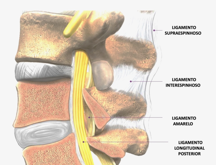 Edema Nos Ligamentos Interespinhosos Entenda Agora Dr Alberto Gotfryd