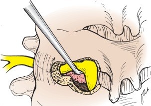 Foraminotomia cervical posterior