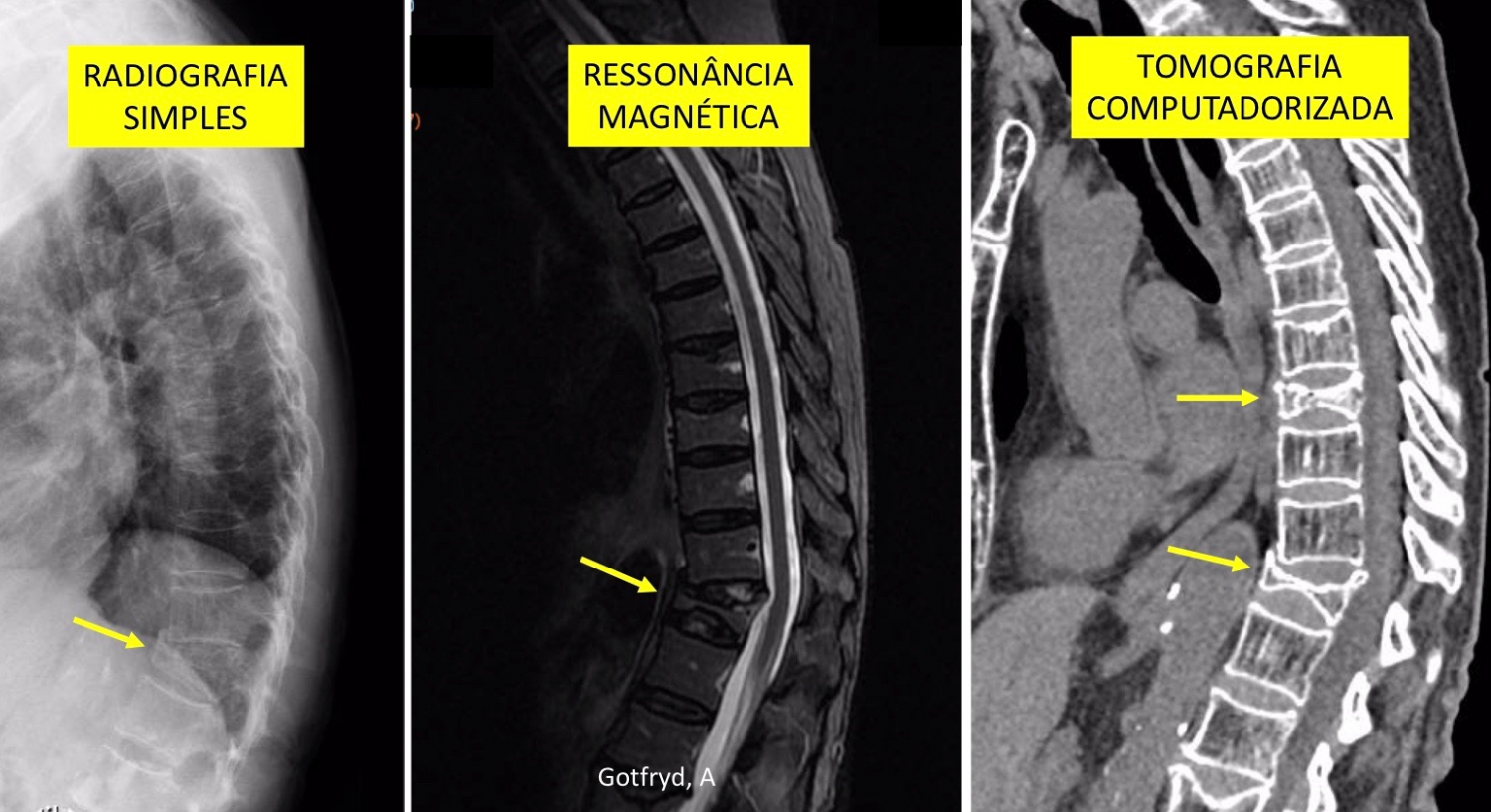 Fraturas Por Osteoporose Na Coluna Entenda O Problema