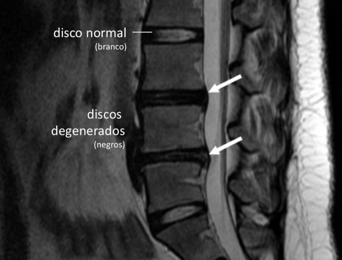 Espondilose S O Desgastes Da Coluna Dr Alberto Gotfryd