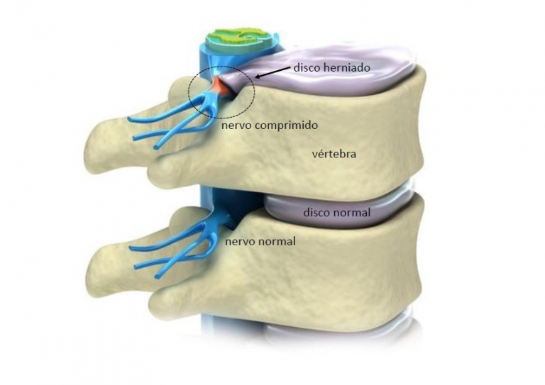 Hérnia De Disco O Que é Sintomas Tratamentos Cirurgias E Causas 0879