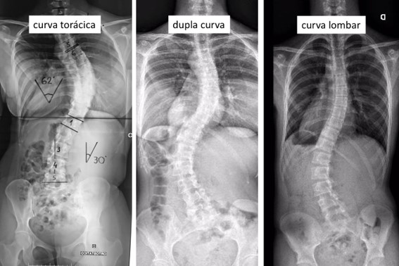 musculação #escoliose #escoliosis #coluna #colunavertebral