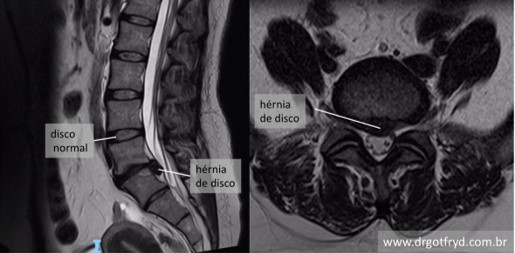 Ressonância magnética: exame de escolha para confirmar diagnóstico de hérnia de disco.