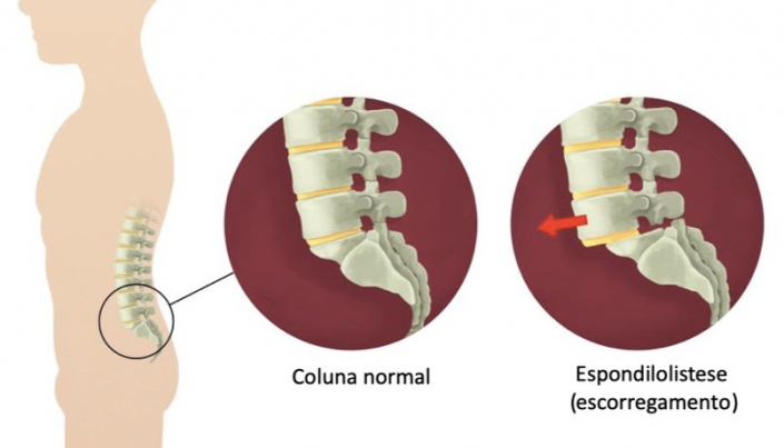 Cid De Coluna Vertebral Dr Alberto Gotfryd