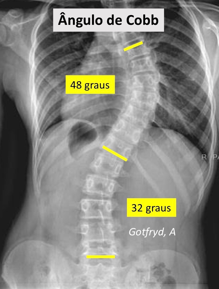 Cid 10 De Coluna Vertebral Dr Alberto Gotfryd