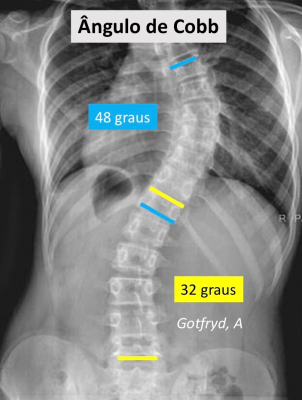 Radiografia de escoliose com ângulos de Cobb.