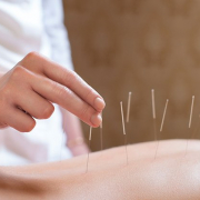 paciente com agulhas de acupuntura para tratamento de coluna
