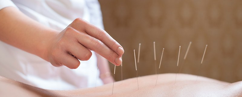 paciente com agulhas de acupuntura para tratamento de coluna