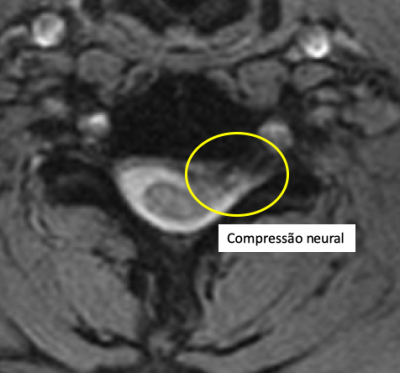 Imagem de ressonância magnética mostrando compressão nervosa na coluna