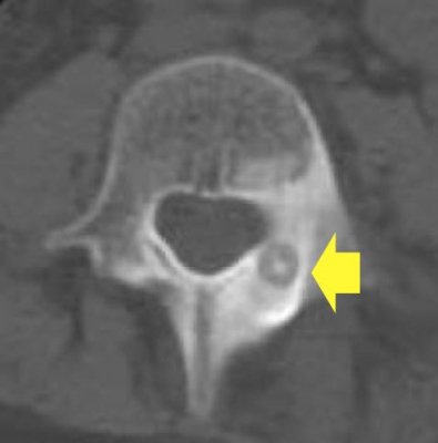 tomografia da coluna com osteoma osteóide
