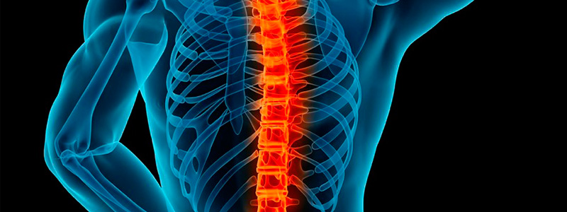 Artrodese da coluna: principais indicações e técnicas - Dr