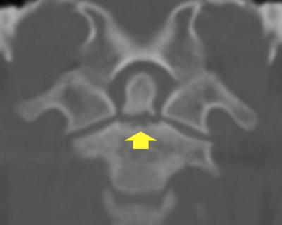 Fratura de coluna em atleta de futebol profissional - Dr. Alberto