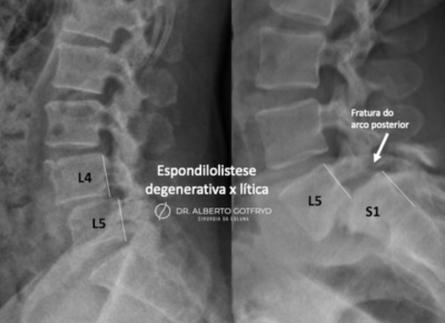 Espondilolistese - Escorregamento vertebral - Dr. Alberto Gotfryd