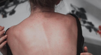 Minha história: fiz cirurgia de escoliose aos 35 anos