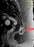Imagem de ressonância magnética que evidencia inflamação óssea no cóccix (seta vermelha).