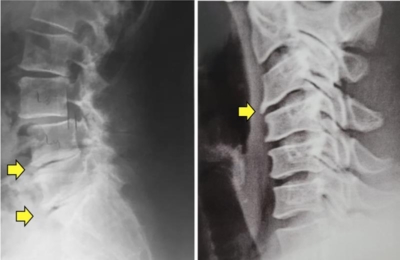 Radiografias da coluna mostrando osteofitose (bicos de pagagaio) na coluna lombar (à esquerda) e cervical (à direita) nas setas amarelas.