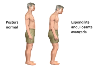 Comparação entre uma postura normal e um postura com espondilite anquilosante avançada