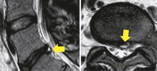 Exame de ressonância magnética da coluna lombossacra. Mas setas amarela é possível identificar fissura do disco intervertebral, que aparece como pequena mancha branca.