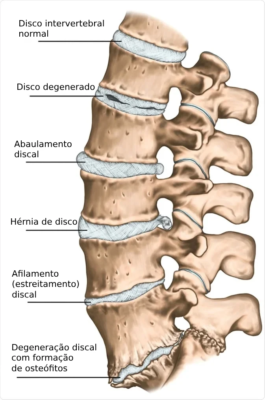 Desenho ilustrativo das diferentes etapas da degeneração do disco intervertebral.