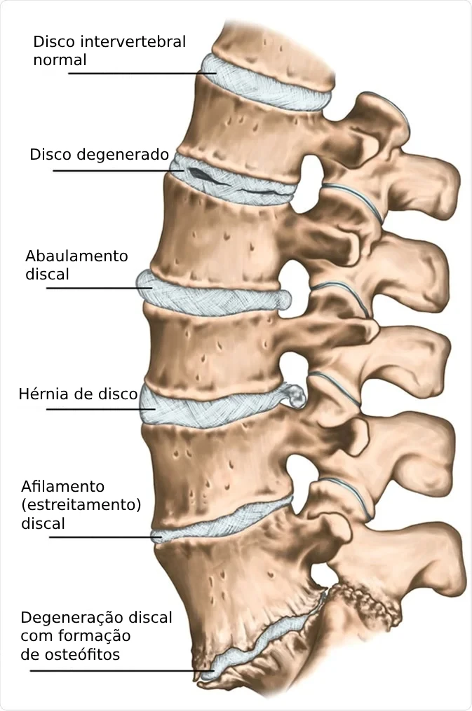 Fases da Hérnia de Disco - Conheça os Estágios da Herniação Discal
