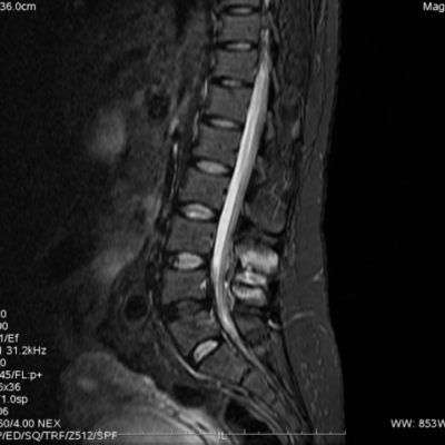 Imagem de ressonância magnética da coluna lombar mostrando áreas esbranquiçadas que correspondem a edema nos ligamentos interespinhosos.